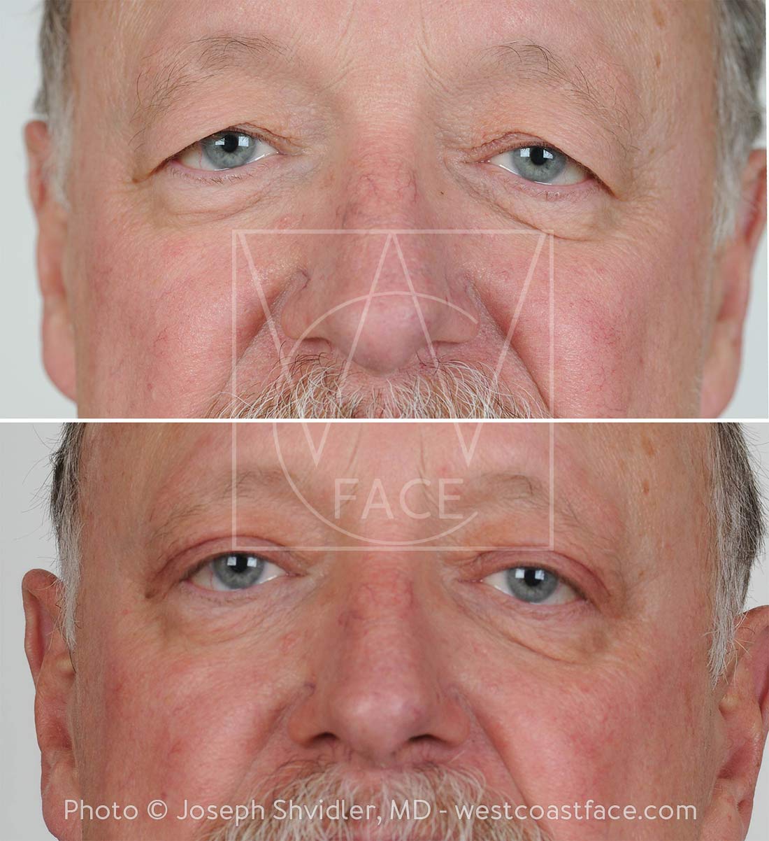 Eyelid Surgery for Men in Tacoma