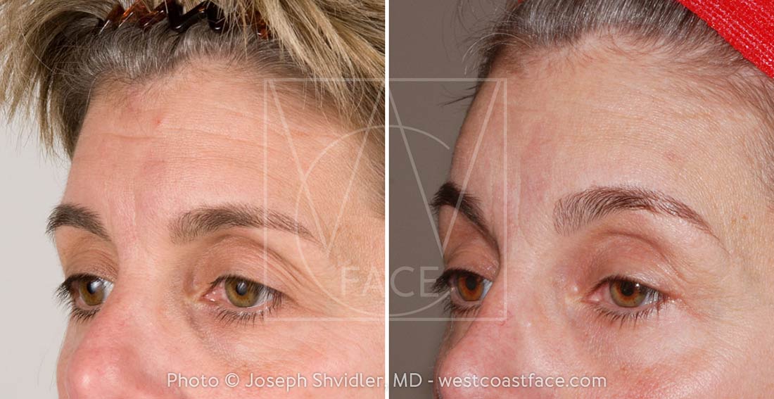 Tacoma Brow Lift Surgery