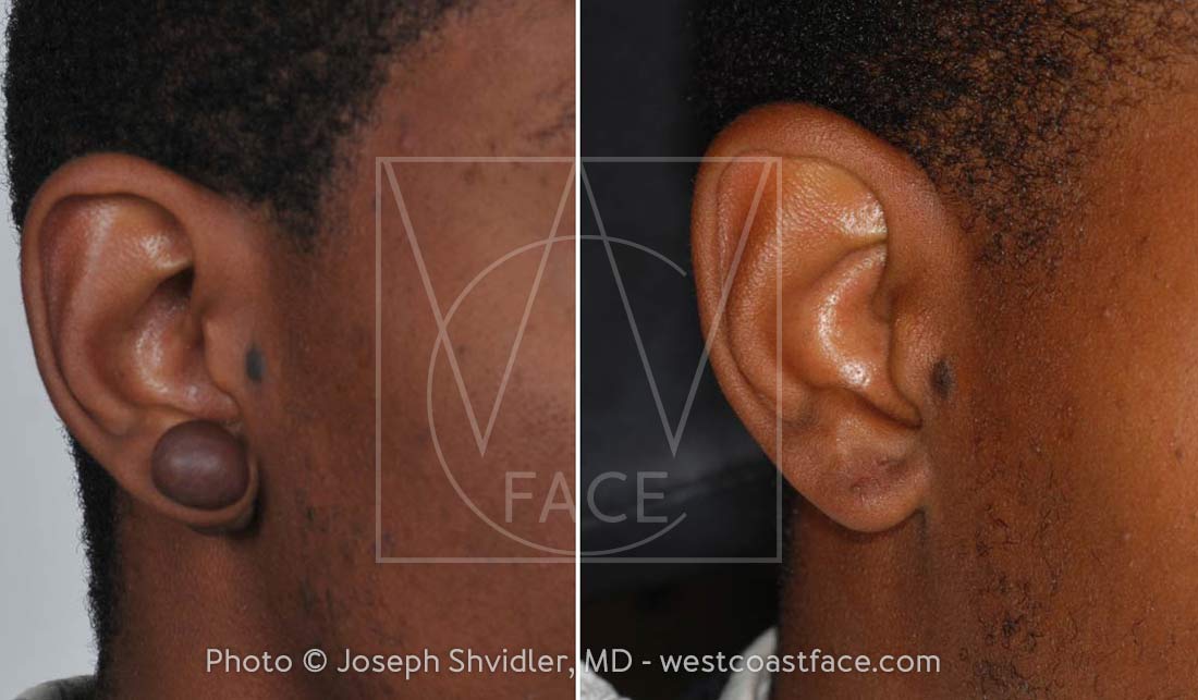 Earlobe Keloids