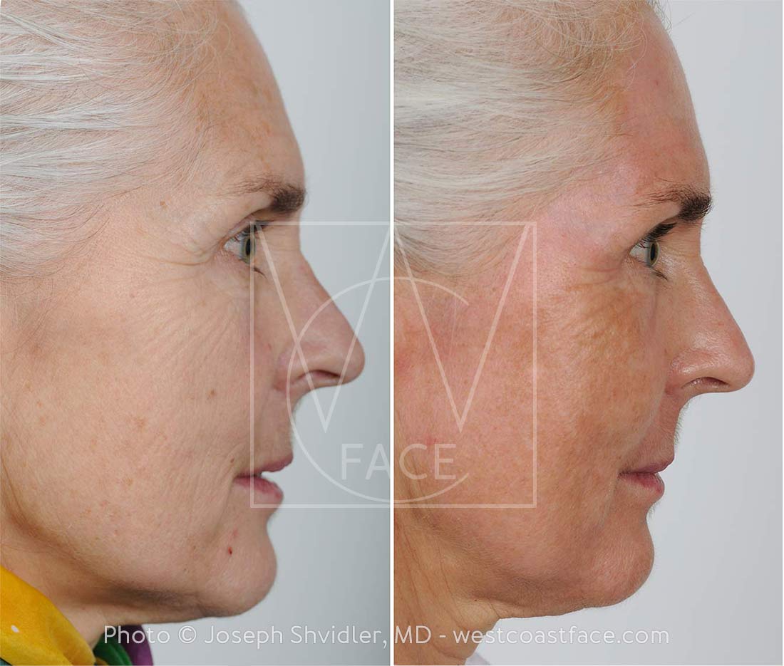 Laser Resurfacing Gig Harbor