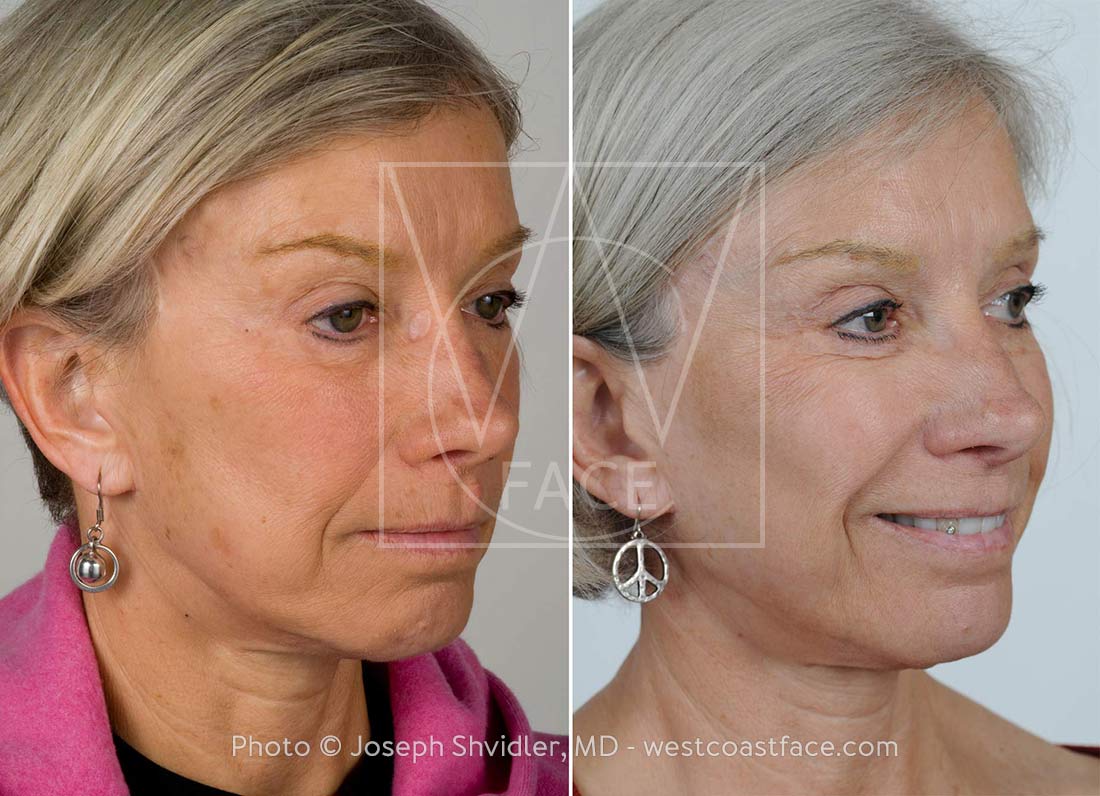 laser resurfacing tacoma