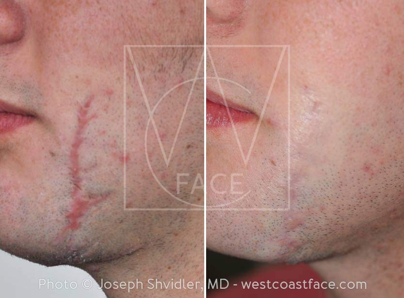 Men Facial scar removal tacoma