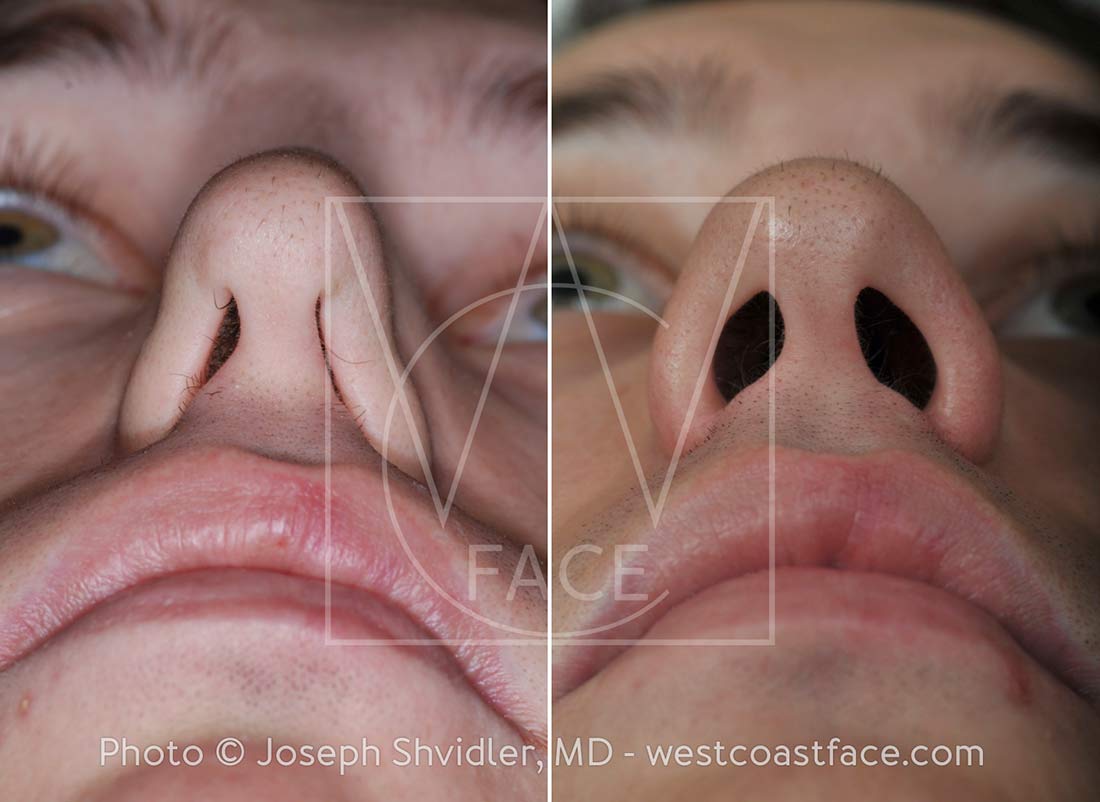 Nasal Valve Collapse Tacoma