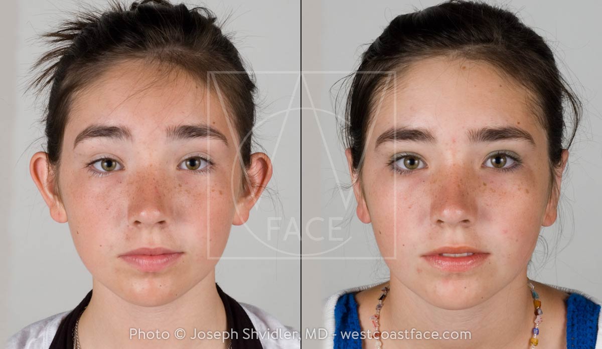 otoplasty gig harbor