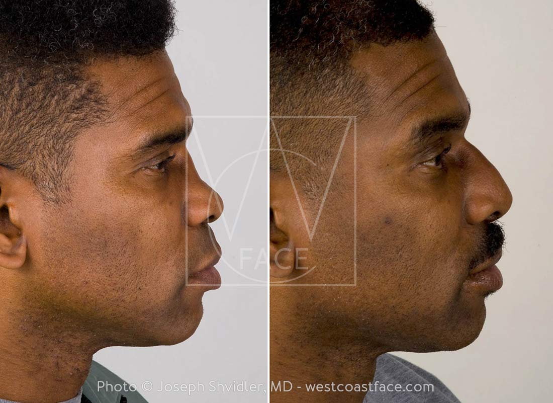 Nose Job Men Tacoma