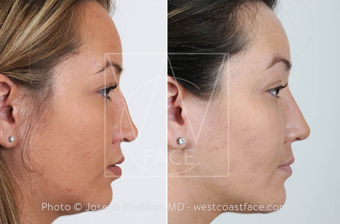 Tacoma Rhinoplasty