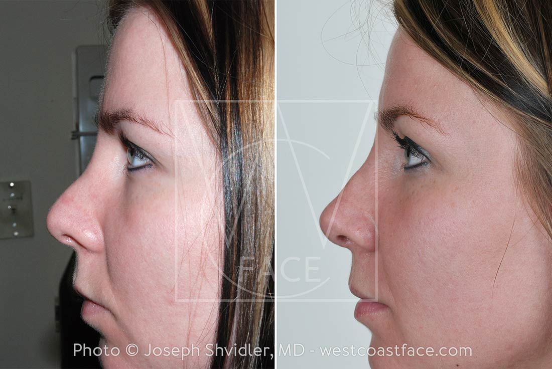 Gig Harbor Rhinoplasty