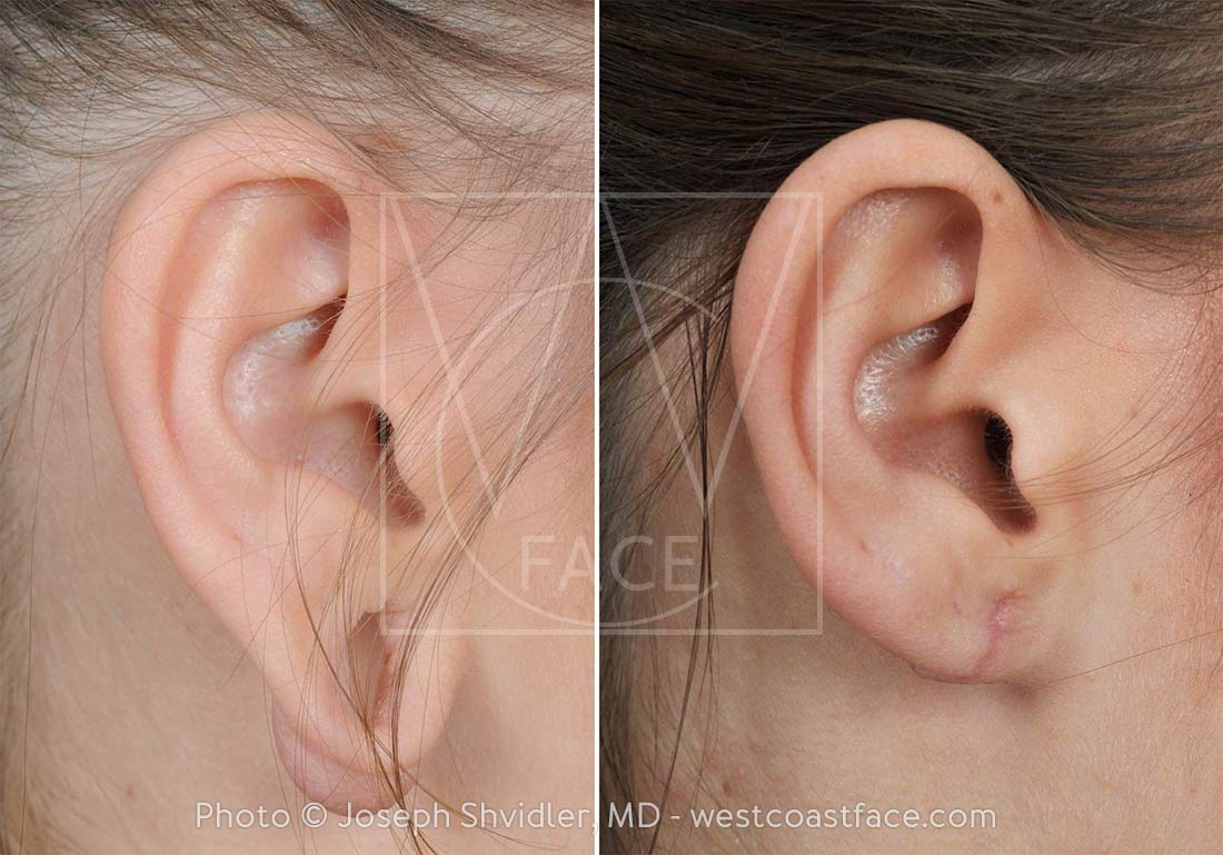 Stretched Earlobes with Gauges