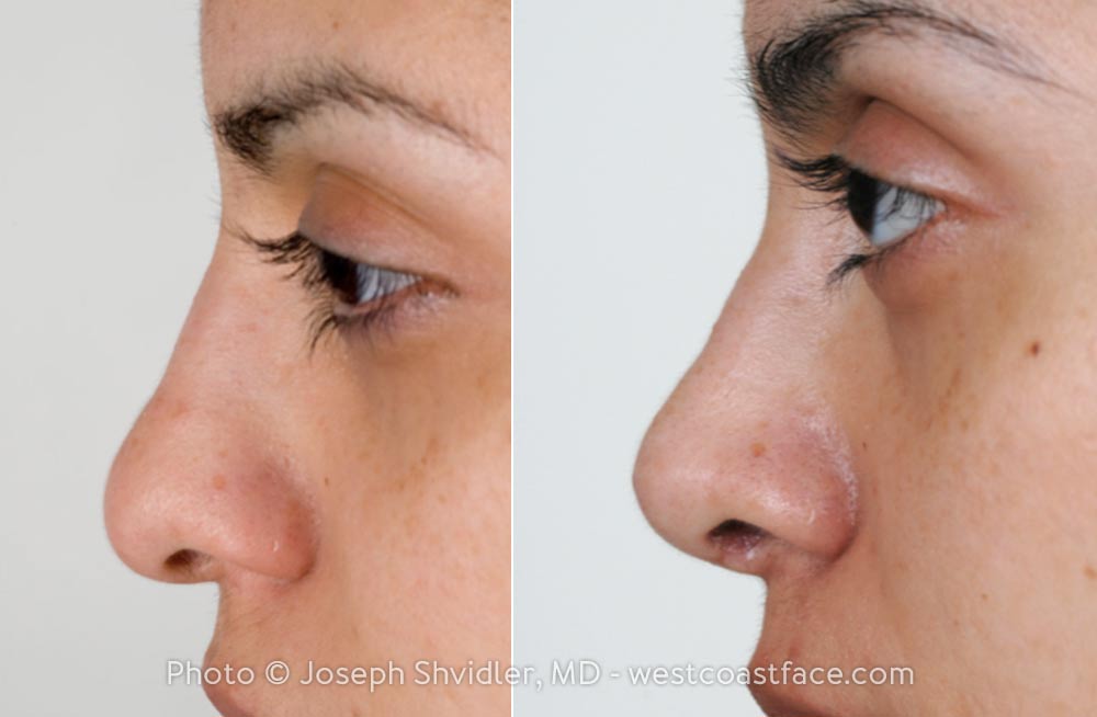 PROCEDURE OF THE WEEK: Nasal Surgery (Rhinoplasty)