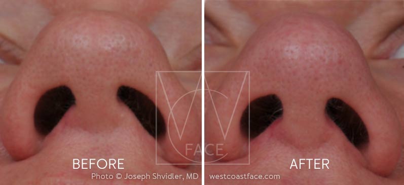 closed tip rhinoplasty