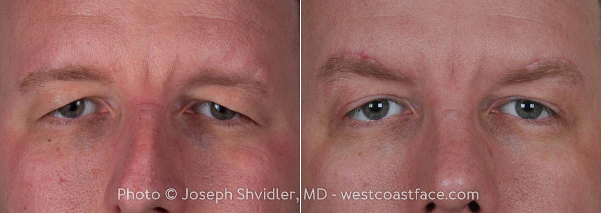 Double eyelid surgery seattle discount