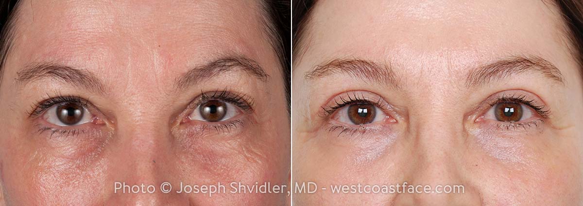 Want an Eye Lift Without Surgery? Here's How