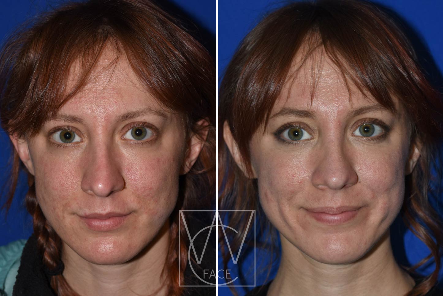 Photo shows before & after of Rhinoplasty patient whose nose was corrected for deviation and tip droop.