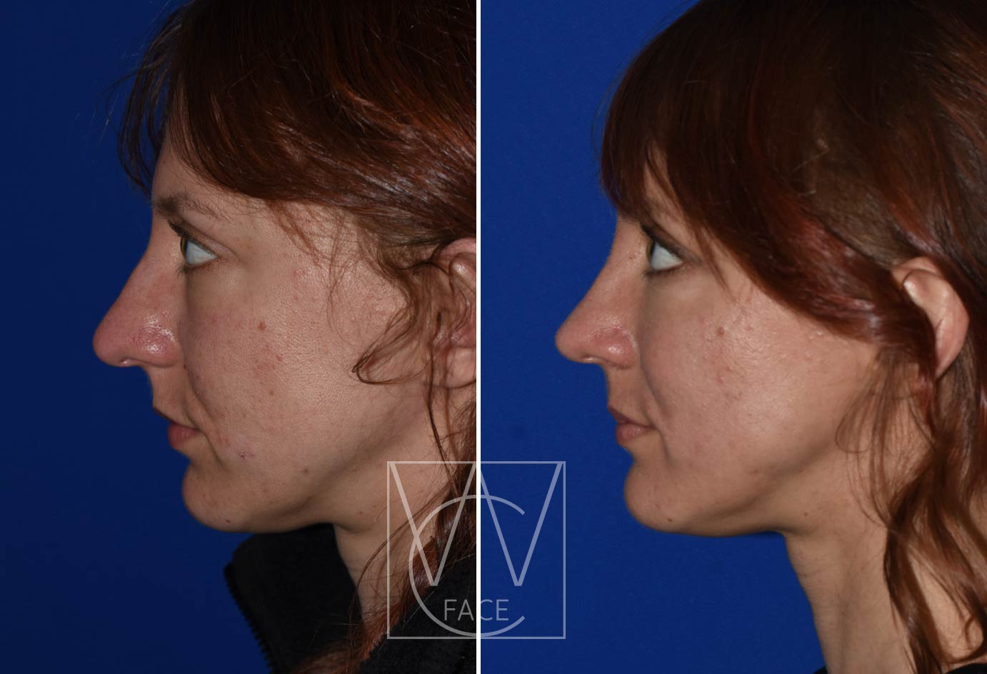 Rhinoplasty patient, side view, removed bump on nose, reduced overall mass and lifted the tip.