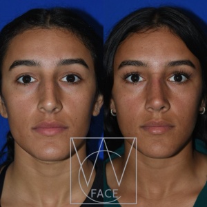 rhinoplasty surgery