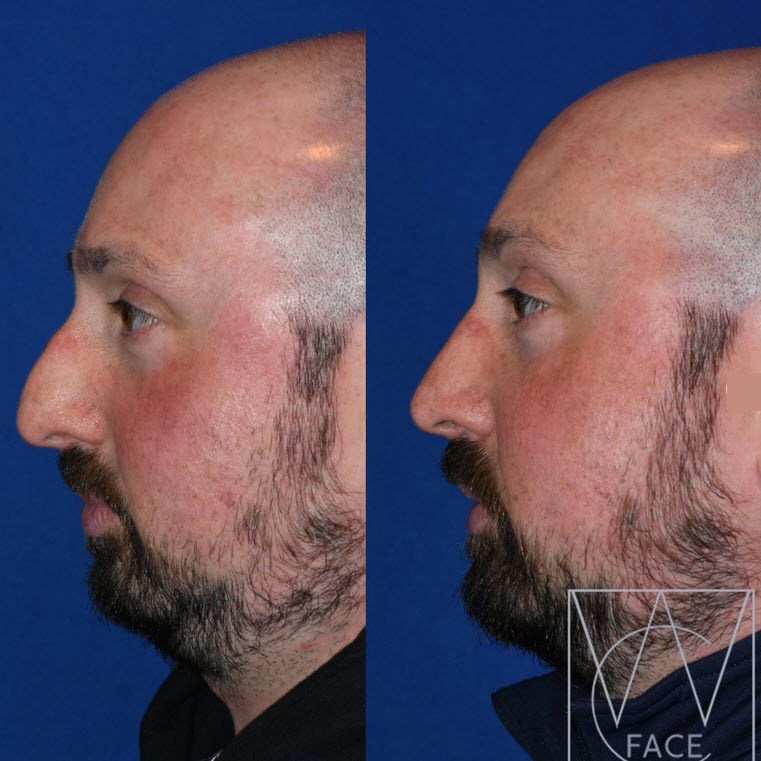rhinoplasty bellevue