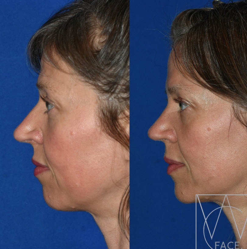 rhinoplasty risks and complications