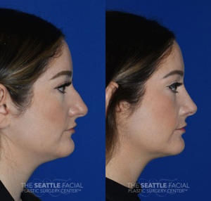 rhinoplasty surgery